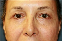 Eyelid Surgery After Photo by Steve Laverson, MD, FACS; Rancho Santa Fe, CA - Case 41464