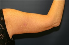 Arm Lift After Photo by Steve Laverson, MD, FACS; Rancho Santa Fe, CA - Case 41516