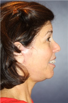 Facelift After Photo by Larry Weinstein, MD; Chester, NJ - Case 41601
