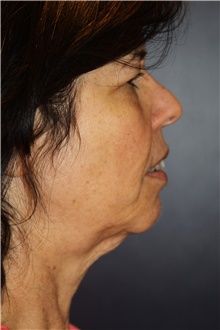 Facelift Before Photo by Larry Weinstein, MD; Chester, NJ - Case 41601