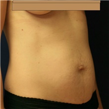 Tummy Tuck Before Photo by Steve Laverson, MD, FACS; Rancho Santa Fe, CA - Case 41646