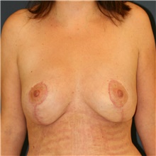 Breast Lift After Photo by Steve Laverson, MD, FACS; Rancho Santa Fe, CA - Case 41664