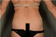 Liposuction After Photo by Ellen Janetzke, MD; ,  - Case 41665