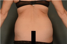 Liposuction Before Photo by Ellen Janetzke, MD; ,  - Case 41665