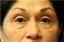 Eyelid Surgery Before Photo by Steve Laverson, MD, FACS; Rancho Santa Fe, CA - Case 41691