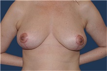 Breast Reduction After Photo by Jerry Weiger Chang, MD, FACS; Flushing, NY - Case 41881