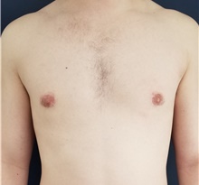 Male Breast Reduction After Photo by Noel Natoli, MD, FACS; East Hills, NY - Case 41908