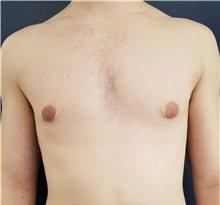Male Breast Reduction Before Photo by Noel Natoli, MD, FACS; East Hills, NY - Case 41908