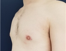 Male Breast Reduction After Photo by Noel Natoli, MD, FACS; East Hills, NY - Case 41908
