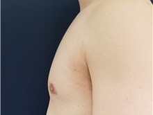 Male Breast Reduction After Photo by Noel Natoli, MD, FACS; East Hills, NY - Case 41908