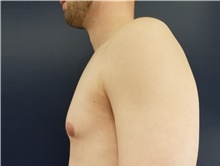 Male Breast Reduction Before Photo by Noel Natoli, MD, FACS; East Hills, NY - Case 41908