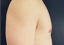 Male Breast Reduction After Photo by Noel Natoli, MD, FACS; East Hills, NY - Case 41908