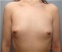Breast Augmentation Before Photo by Ellen Mahony, MD; Westport, CT - Case 41941
