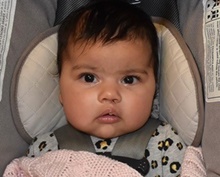 Cleft Lip and Palate Repair After Photo by Rachel Ruotolo, MD; Garden City, NY - Case 42057