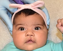 Cleft Lip and Palate Repair Before Photo by Rachel Ruotolo, MD; Garden City, NY - Case 42057