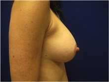 Breast Augmentation After Photo by Nicholas Leonardi, DO; ,  - Case 42428