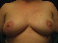 Breast Reconstruction After Photo by Nicholas Leonardi, DO; ,  - Case 42437