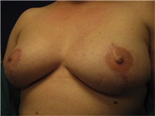 Breast Reconstruction After Photo by Nicholas Leonardi, DO; ,  - Case 42437