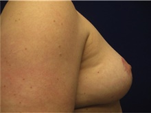 Breast Reconstruction After Photo by Nicholas Leonardi, DO; ,  - Case 42437