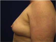 Breast Reconstruction Before Photo by Nicholas Leonardi, DO; ,  - Case 42437