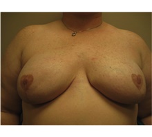 Breast Reconstruction After Photo by Nicholas Leonardi, DO; ,  - Case 42439