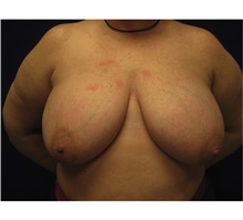 Breast Reconstruction Before Photo by Nicholas Leonardi, DO; ,  - Case 42439