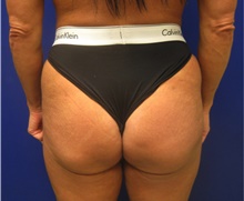 Buttock Lift with Augmentation After Photo by Nicholas Leonardi, DO; ,  - Case 42442