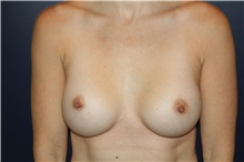 Breast Augmentation After Photo by Larry Weinstein, MD; Chester, NJ - Case 42554