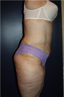 Body Contouring After Photo by Larry Weinstein, MD; Chester, NJ - Case 42555