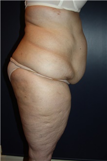 Body Contouring Before Photo by Larry Weinstein, MD; Chester, NJ - Case 42555