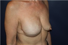 Breast Reconstruction Before Photo by Larry Weinstein, MD; Chester, NJ - Case 42559