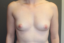Breast Augmentation Before Photo by Sean Doherty, MD; Chestnut Hill, MA - Case 42754