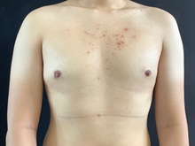Male Breast Reduction After Photo by Sean Doherty, MD; Chestnut Hill, MA - Case 42761