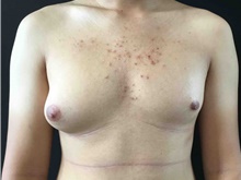 Male Breast Reduction Before Photo by Sean Doherty, MD; Chestnut Hill, MA - Case 42761