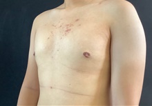 Male Breast Reduction After Photo by Sean Doherty, MD; Chestnut Hill, MA - Case 42761