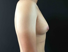 Male Breast Reduction Before Photo by Sean Doherty, MD; Chestnut Hill, MA - Case 42761