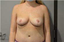 Breast Reduction After Photo by Ellen Janetzke, MD; ,  - Case 42772