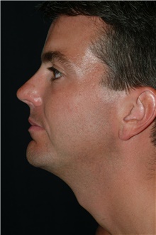 Chin Augmentation After Photo by Brian Hass, MD; ,  - Case 43000