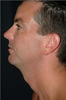 Chin Augmentation Before Photo by Brian Hass, MD; ,  - Case 43000