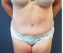 Tummy Tuck After Photo by Noel Natoli, MD, FACS; East Hills, NY - Case 43341