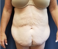 Tummy Tuck Before Photo by Noel Natoli, MD, FACS; East Hills, NY - Case 43341
