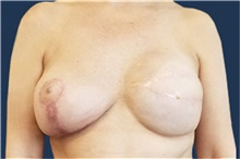 Breast Reconstruction After Photo by Noel Natoli, MD, FACS; East Hills, NY - Case 43347