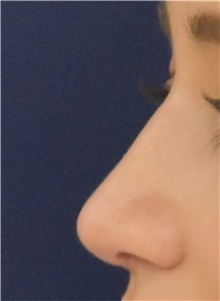 Rhinoplasty After Photo by Richard Reish, MD, FACS; New York, NY - Case 43450