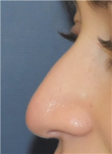 Rhinoplasty Before Photo by Richard Reish, MD, FACS; New York, NY - Case 43450