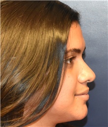 Rhinoplasty Before Photo by Richard Reish, MD, FACS; New York, NY - Case 43507