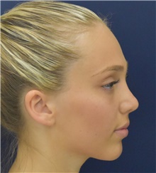 Rhinoplasty After Photo by Richard Reish, MD, FACS; New York, NY - Case 43543