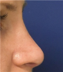 Rhinoplasty After Photo by Richard Reish, MD, FACS; New York, NY - Case 43563
