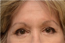 Botulinum Toxin After Photo by Carlos Rivera-Serrano, MD; ,  - Case 43633