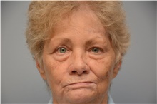 Brow Lift After Photo by Carlos Rivera-Serrano, MD; ,  - Case 43665