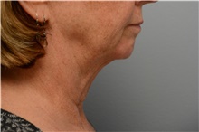 Chin Augmentation Before Photo by Carlos Rivera-Serrano, MD; ,  - Case 43671